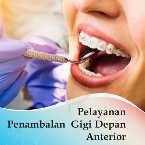 PENAMBALAN GIGI TETAP ANTERIOR - KLINIK STELLA MEDIKA